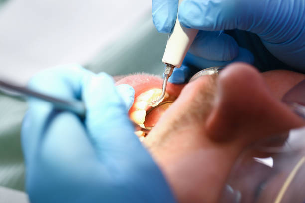 Best Emergency Treatment for Dental Infections or Abscesses in Cottleville, MO